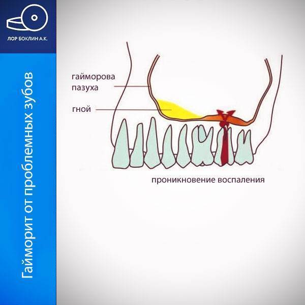 Верхнечелюстной синусит презентация