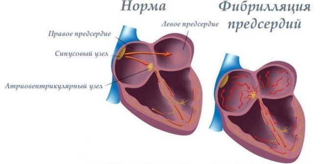 Ритмокор (rhythmocor)