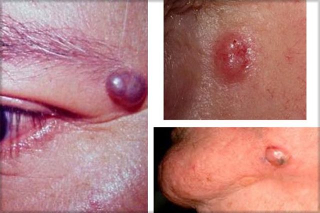 Базалиома на лице – фото кожи, симптомы, методы лечения на разных стадиях