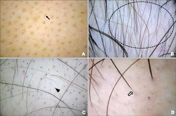 Лечение алопеции: когда выпадение волос превращается в болезнь?