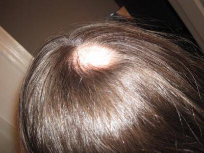 Грибок кожи головы: симптомы, причины, лечение