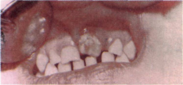 Потемнение эмали на передних зубах лечение