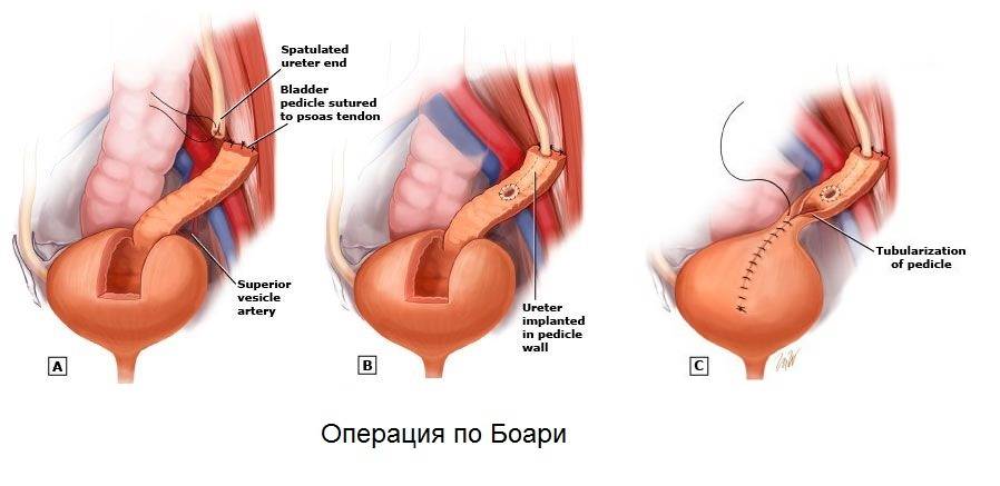 Подковообразная почка у ребенка чем опасна