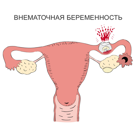 Внематочная беременность — большая медицинская энциклопедия