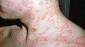 Аллергия на лекарства: фото, симптомы, как выглядят высыпания на коже
