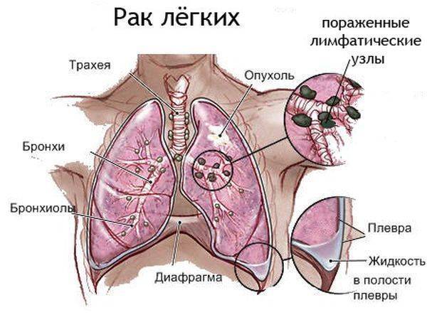 При кашле болит справа под ребрами сбоку что