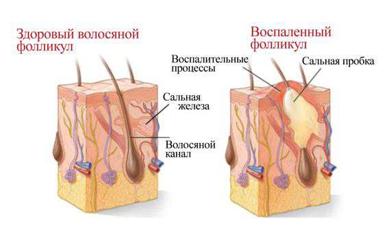 Атерома на голове: удаление с волосистой части кожи, причины, лечение