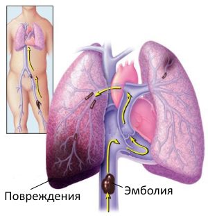Тромбоэмболия легочной артерии. причины, симптомы, признаки, диагностика и лечение патологии. :: polismed.com