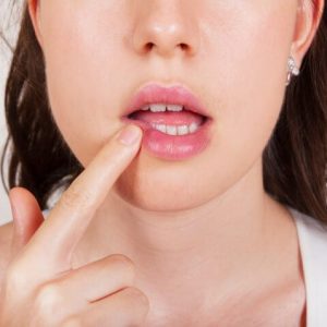 Причины появления и лечение заедов в уголках рта