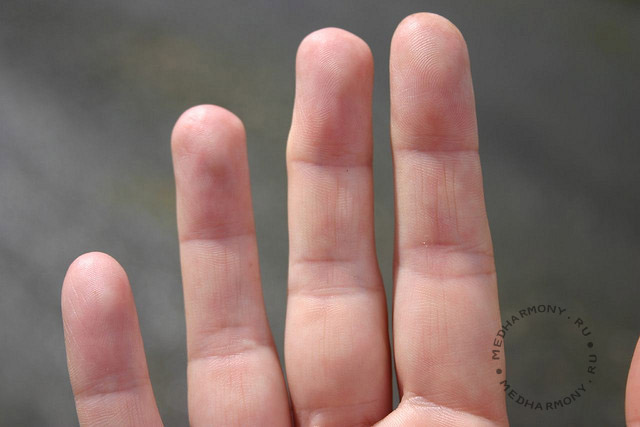 Ревматоидный артрит пальцев рук: первые симптомы и методы лечения