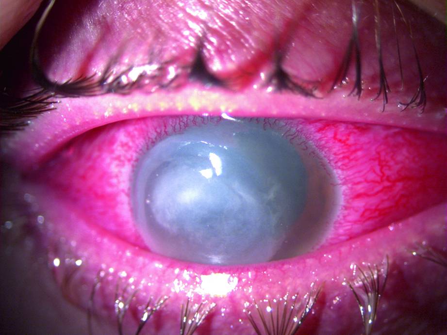 Воспаление роговой оболочки глаз (кератит): что это такое и как лечить