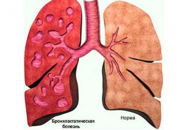 Пневмосклероз легких | eurolab | пульмонология
