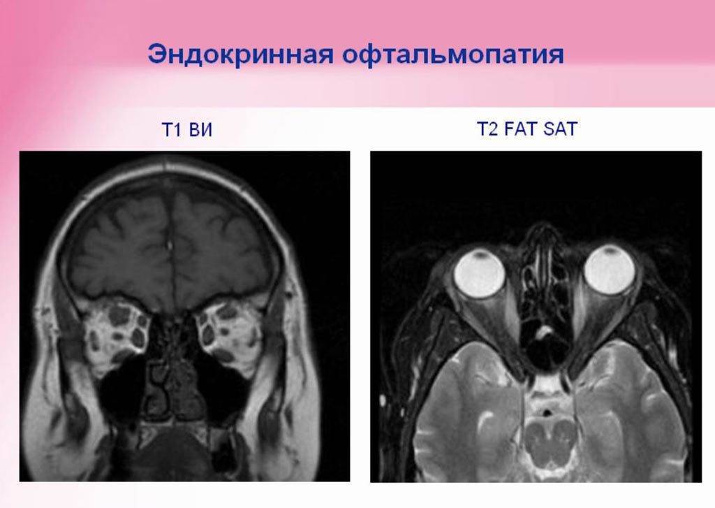 Офтальмопатия при тиреотоксикозе фото