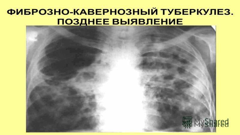 Каверна при туберкулезе. Фиброзно-кавернозный туберкулез рентген. Кавернозный туберкулез рентгенограмма. Фиброзно-кавернозный туберкулез легких рентген. Кавернозный туберкулез фтизиатрия.