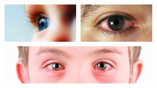 Бактериальный конъюнктивит глаз лечение у взрослых капли