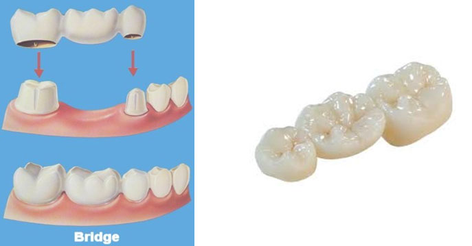 Мостовидный протез из металлокерамики — эффективное восстановление зубного ряда, обзор цен