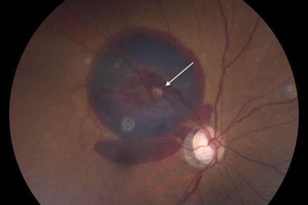 Кровоизлияние в глаз: что делать, причины и лечение, симптомы, диагностика