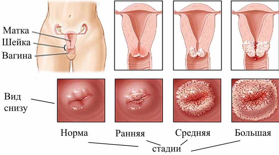 Лечение эрозии шейки матки при разных симптомах