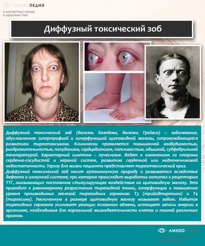 Симптом экзофтальма глаз - причины появления и лечение. сайт "московская офтальмология"