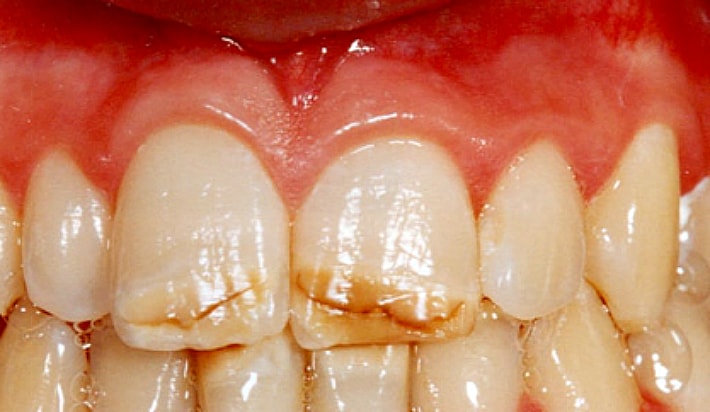 Потемнение эмали зубов