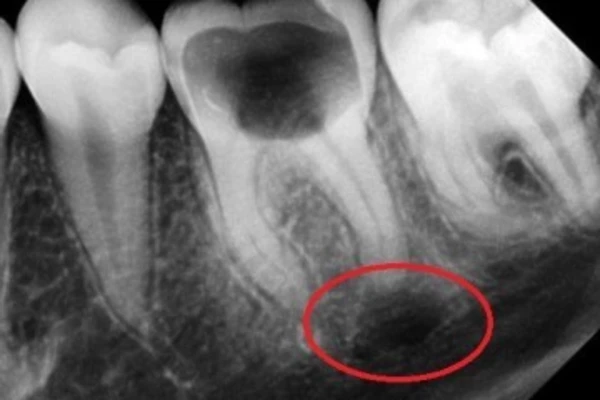 Киста зуба – симптомы. киста на корне зуба – лечение или удаление?