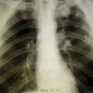 Как передается туберкулез от человека к человеку. очаговый туберкулез легких: заразен или нет, лечение, симптомы, сколько лечиться и как передается