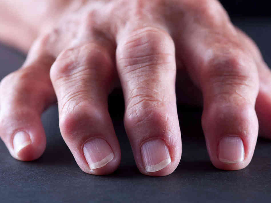 Что представляет из себя артрит суставов пальцев рук?