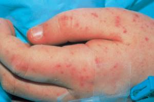Менингококковая инфекция у детей: симптомы, лечение и профилактика