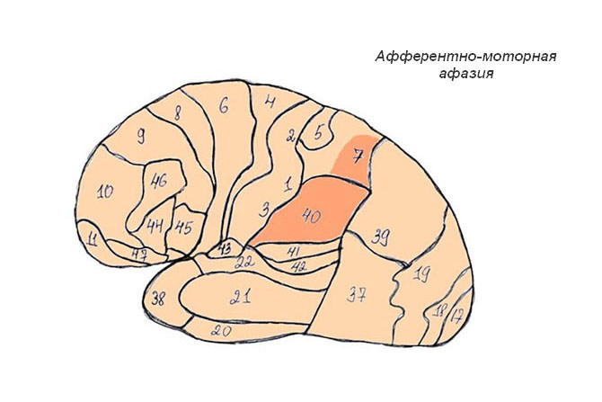 Афферентная моторная афазия презентация