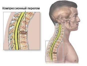 Компрессионный перелом позвоночника у детей: лечение и реабилитация, симптомы и последствия, при переломе грудного отдела