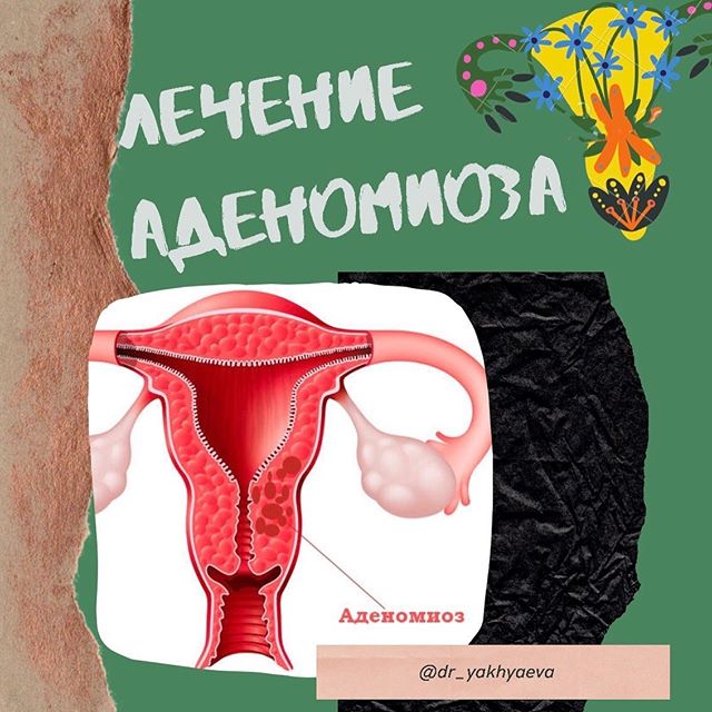 Аденомиоз матки: формы, степени, факторы и природа заболевания