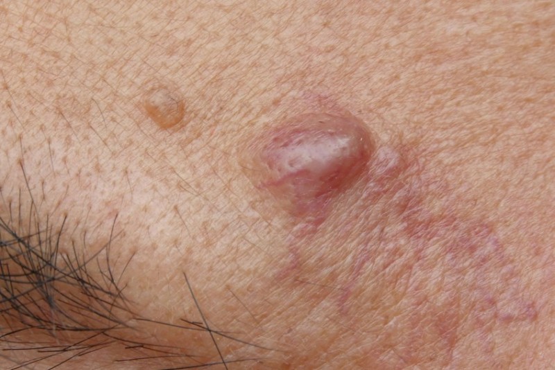 Закупорка сальных желез на лице, спине: лечение воспаления