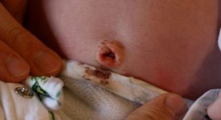 Пупок  кровит у новорожденного - пупок у новорожденного кровит - запись пользователя белла (belochkaislon) в сообществе здоровье новорожденных в категории разное - babyblog.ru