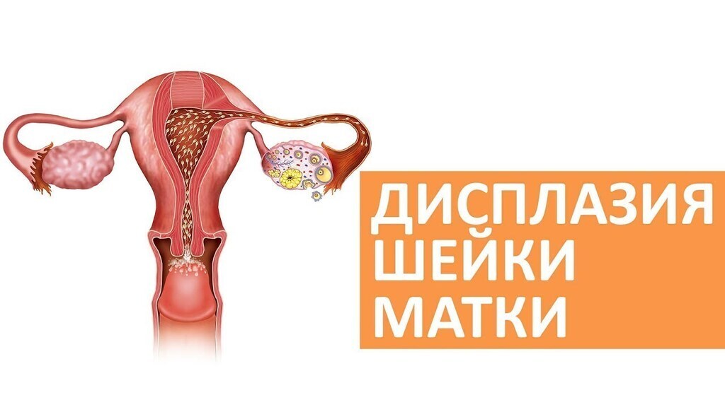Рак шейки матки - самый распространенный вид онкологии среди женщин