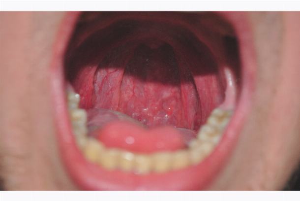 Кандидоз гортани: грибковое поражение носоглотки, симптомы и лечение
