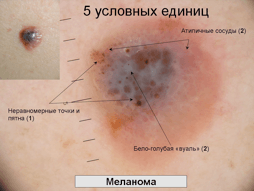 Меланома – фото начальная стадия. фото меланом