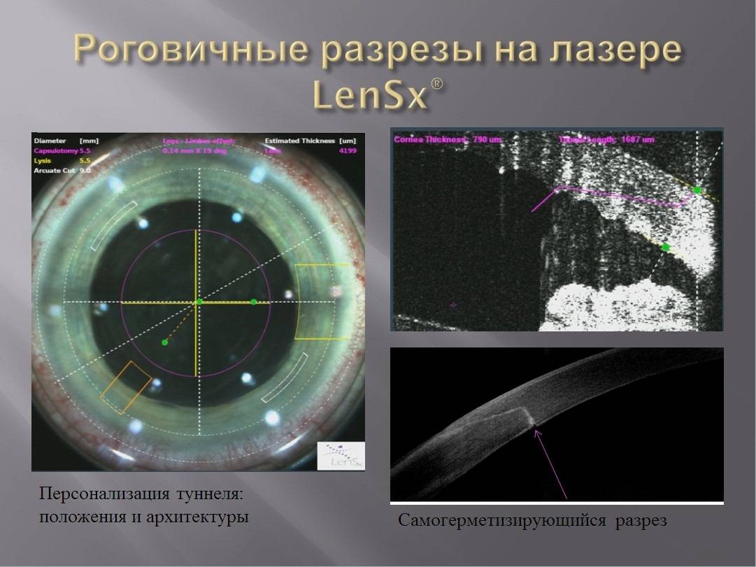 Как восстанавливается зрение после лазерной. LENSX Alcon фемтосекундный лазер.