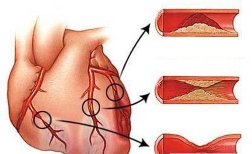 Лечение антагонистами кальция больных ишемической болезнью сердца
