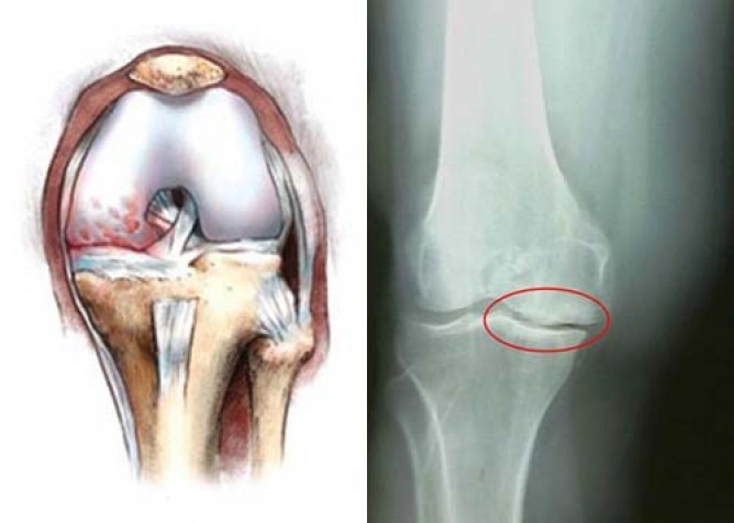 Мениск колена: причины, симптомы повреждения и лечение