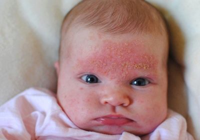 Шелушение кожи у новорожденных