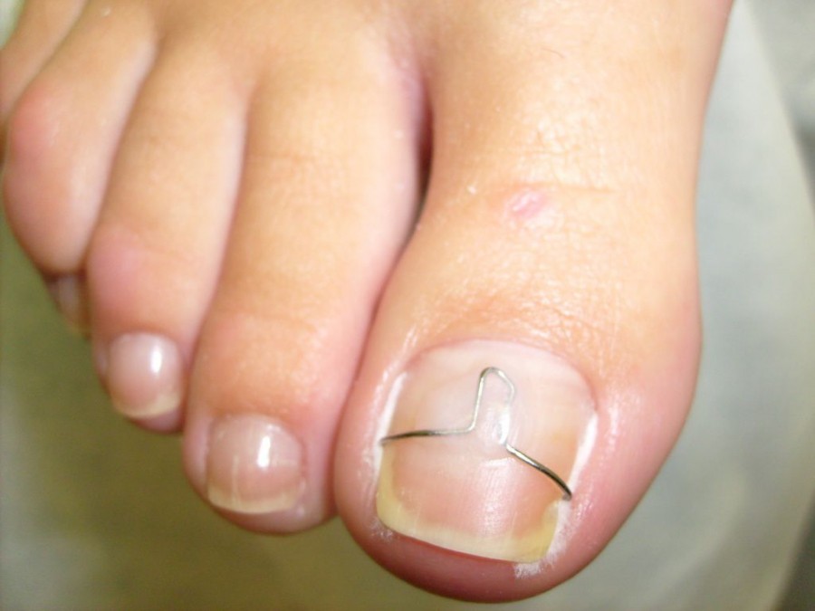 Вросший ноготь на большом пальце ноги лечение удаление