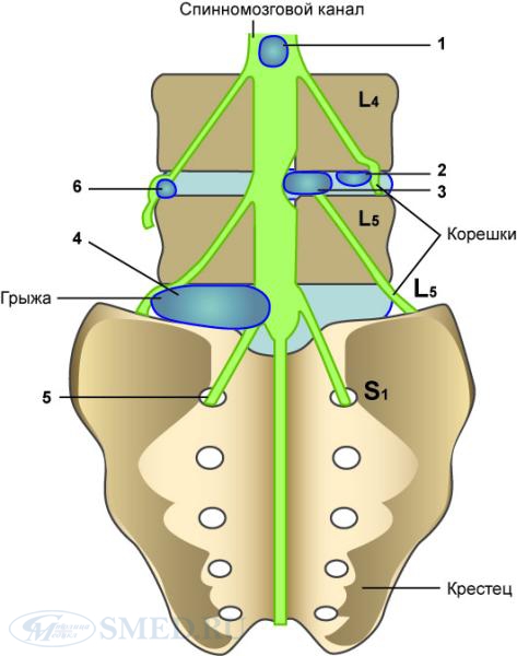 S 1 5 6. Корешки l4 l5. Корешок l5. Корешок позвоночника поясничного отдела l5-s1. Грыжи позвонков. L4,l5, , схему соединения.
