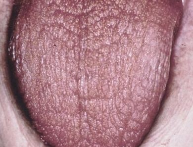 Когда поцелуи становятся кислыми - болезнь шегрена