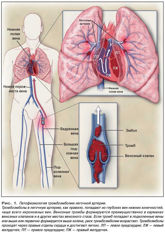Тромбоэмболия легочной артерии (тэла): симптомы, лечение и диагностика
