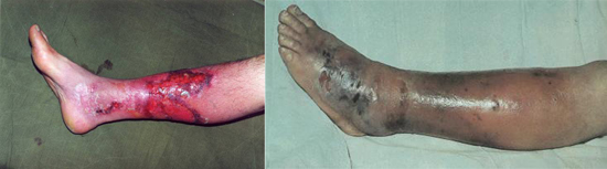 Заболевание рожа на ноге симптомы лечение народными средствами
