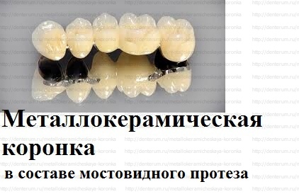 Протезирование зубов на имплантах: цена полного зубного протезирования в москве