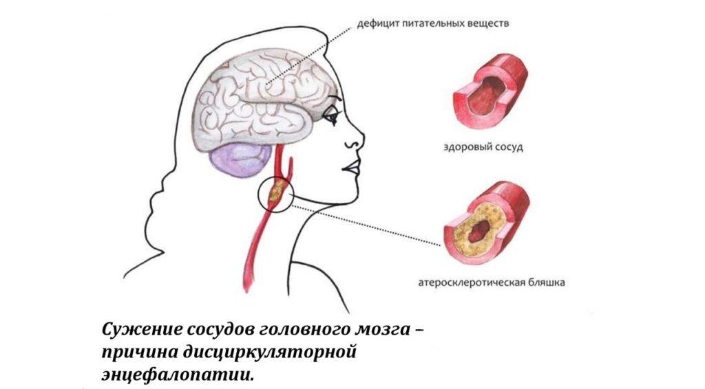 Признаки энцефалопатии мозга. Энцефалопатия симптомы. Дисциркуляторная энцефалопатия.