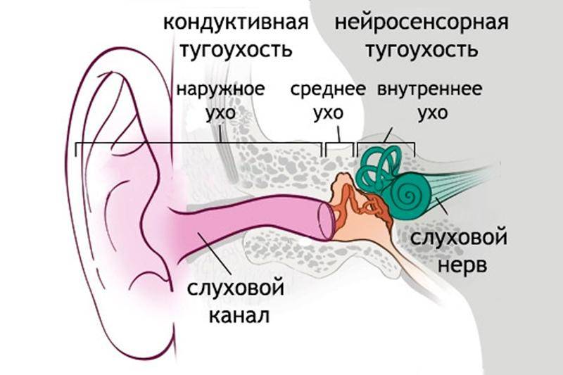 Нейросенсорная тугоухость профессиональное заболевание презентация