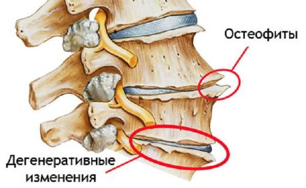 Где болит голова при шейном остеохондрозе фото