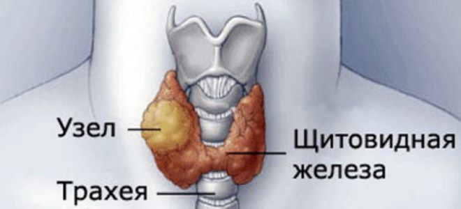 Неоднородная структура щитовидной железы: что это такое